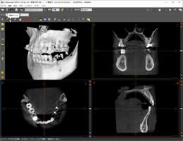 CTの3Dシミュレーション画像